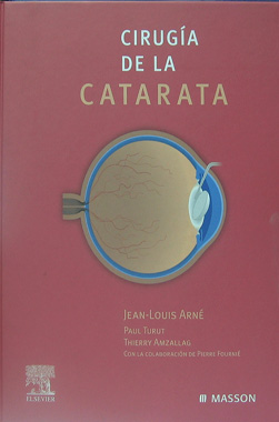 Cirugia de la Catarata