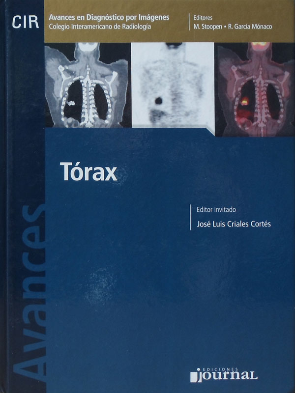 Libro: Avances en Diagnostico por Imagenes: Torax Autor: M. Stoopen, R. Garcia Monaco